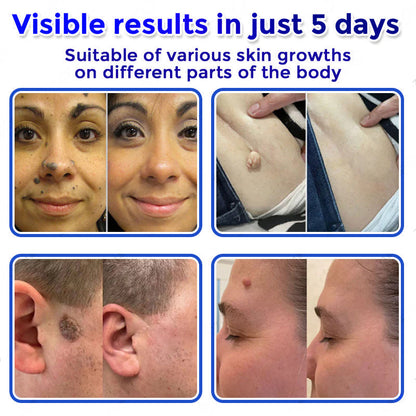 👑☘️Celsiora® 2-in-1 Microneedle & Hydrocolloid Patch | Raised Moles,Acne, Flat Warts & Skin Tags Remover | Improves Wrinkles, Scars & Blemishes | Invisible Pimple Patches for Face & Body | 24 Count