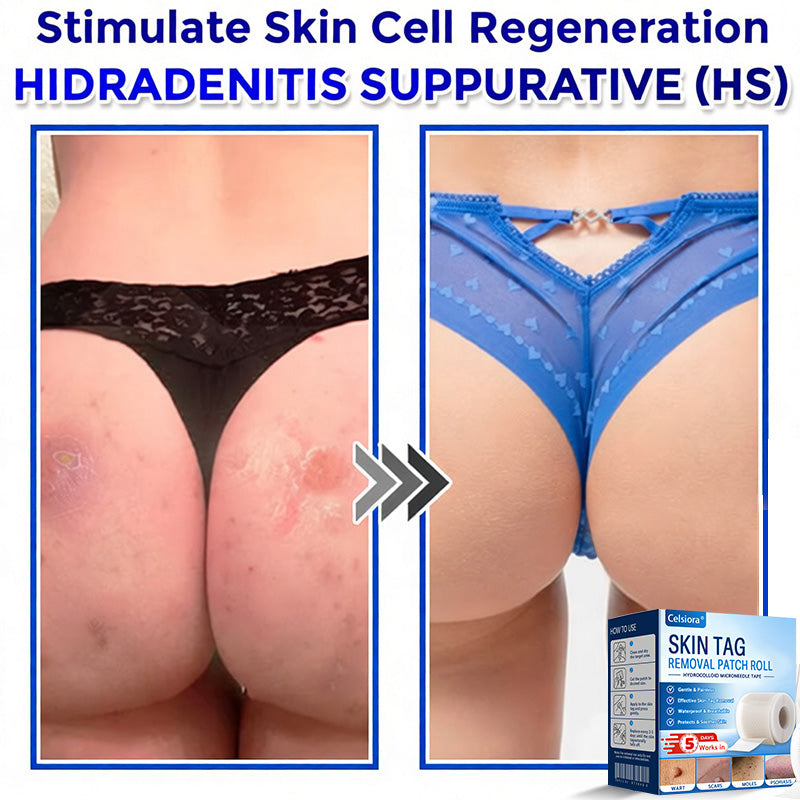 👑👑Celsiora® Multi-Functional Microneedle Hydrocolloid Patch Roll | Targets Skin Tags, Warts & Stubborn Blemishes