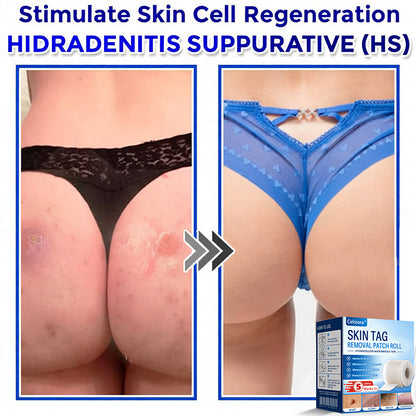 👑👑Celsiora® Multi-Functional Microneedle Hydrocolloid Patch Roll | Targets Skin Tags, Warts & Stubborn Blemishes