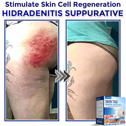 👑👑Celsiora® Multi-Functional Microneedle Hydrocolloid Patch Roll | Targets Skin Tags, Warts & Stubborn Blemishes