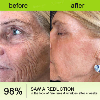 💫💯Made and shipped from the UK 💫Rolimey® Botox & Vita-A Retinol Shot Wrinkle-Lift Tightening cream - Last Day Promotion 50% OFF