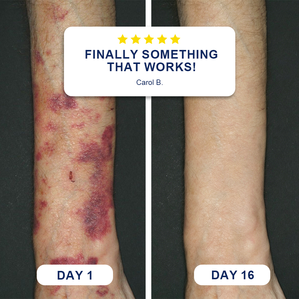 ✨✨Evolvion® Bruise Care Balm  Skin-Strengthening Formula for Mature Skin