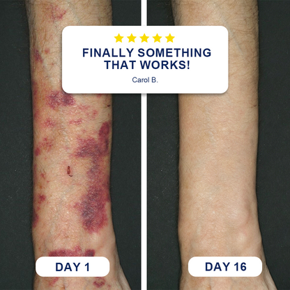 ✨✨Evolvion® Bruise Care Balm  Skin-Strengthening Formula for Mature Skin