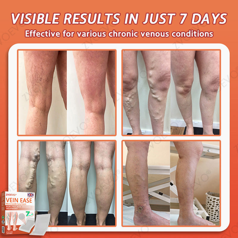 😍🎁Zvoevo® Vein Ease Microneedle Care Patch(For Spider Veins, Varicose Veins, Swelling & Leg Fatigue)