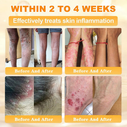 🌿👨‍⚕️Rolimey® Bee Venom Skin Restoration Cream（Anti-aging, Hydrating, Skin Repair, Even Tone, Acne and Dark Spot Treatment, Wart and Mole Removal, Psoriasis Relief)