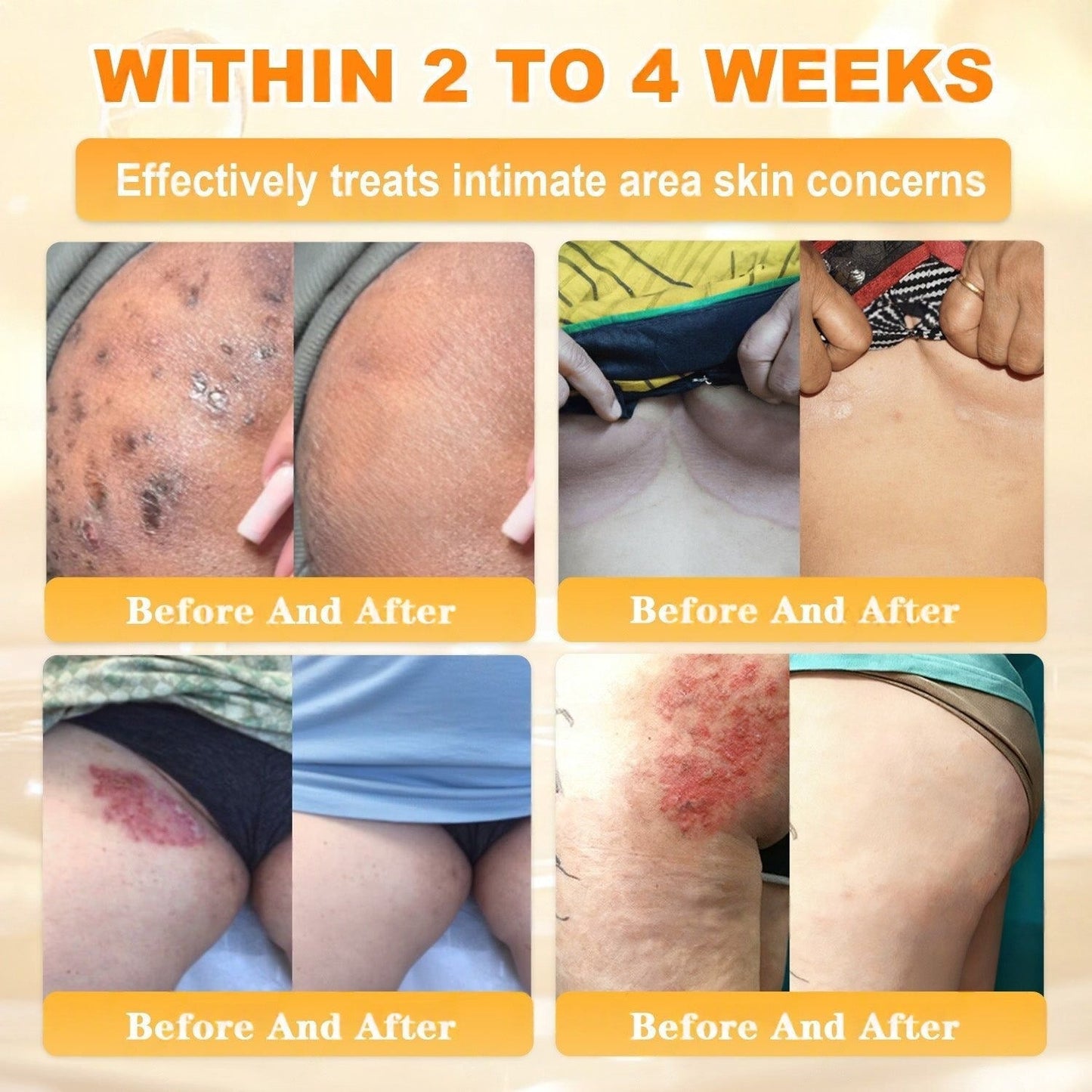 🌿👨‍⚕️Rolimey® Bee Venom Skin Restoration Cream（Anti-aging, Hydrating, Skin Repair, Even Tone, Acne and Dark Spot Treatment, Wart and Mole Removal, Psoriasis Relief)