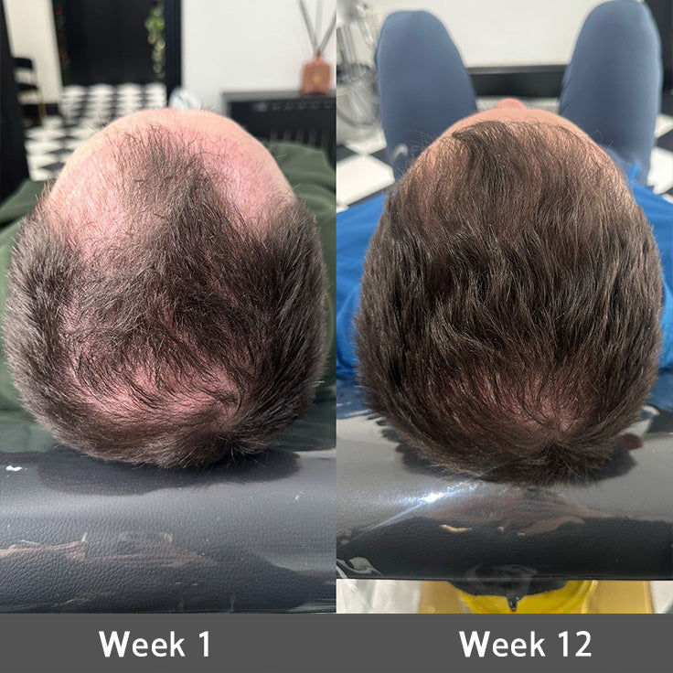 👨‍⚕️💟 Official UK Store 🇬🇧 | 🔥Rolimey® Highly Effective Biotin & Rosemary Hair Growth Serum — (🔥 Limited-Time Offer, ⏳ Last Day Promotion 50% OFF)