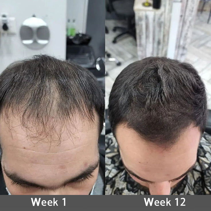 👨‍⚕️💟 Official UK Store 🇬🇧 | 🔥Rolimey® Highly Effective Biotin & Rosemary Hair Growth Serum — (🔥 Limited-Time Offer, ⏳ Last Day Promotion 50% OFF)