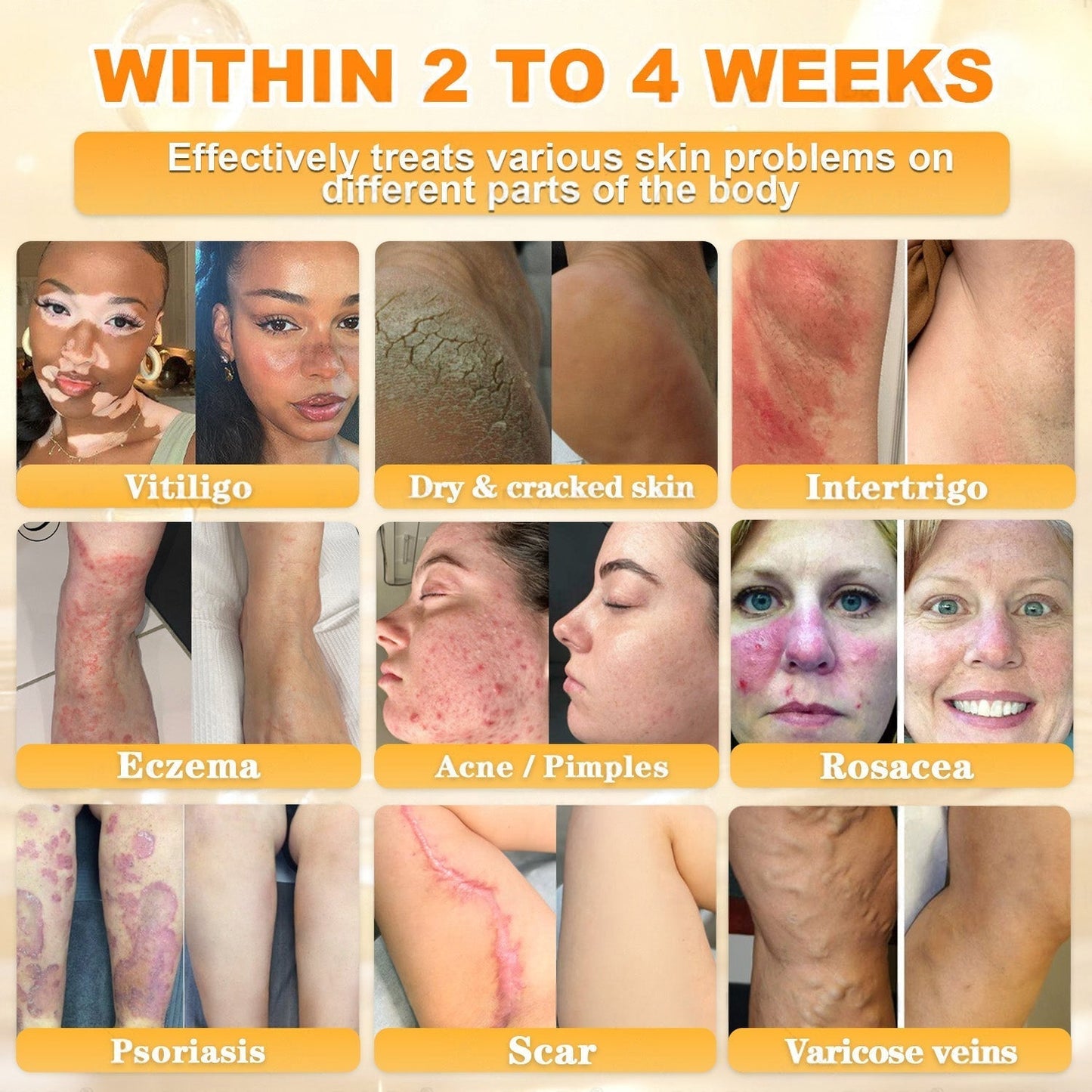🌿👨‍⚕️Rolimey® Bee Venom Skin Restoration Cream（Anti-aging, Hydrating, Skin Repair, Even Tone, Acne and Dark Spot Treatment, Wart and Mole Removal, Psoriasis Relief)