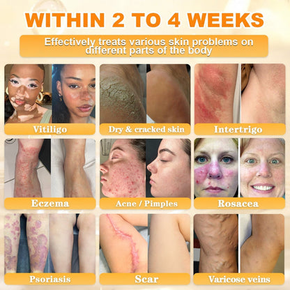 🌿👨‍⚕️Rolimey® Bee Venom Skin Restoration Cream（Anti-aging, Hydrating, Skin Repair, Even Tone, Acne and Dark Spot Treatment, Wart and Mole Removal, Psoriasis Relief)