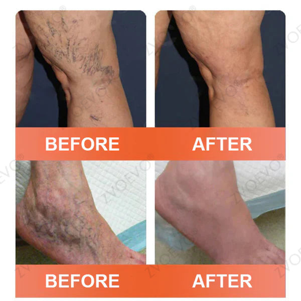 😍🎁Zvoevo® Vein Ease Microneedle Care Patch(For Spider Veins, Varicose Veins, Swelling & Leg Fatigue)