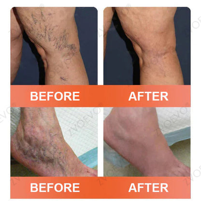😍🎁Zvoevo® Vein Ease Microneedle Care Patch(For Spider Veins, Varicose Veins, Swelling & Leg Fatigue)