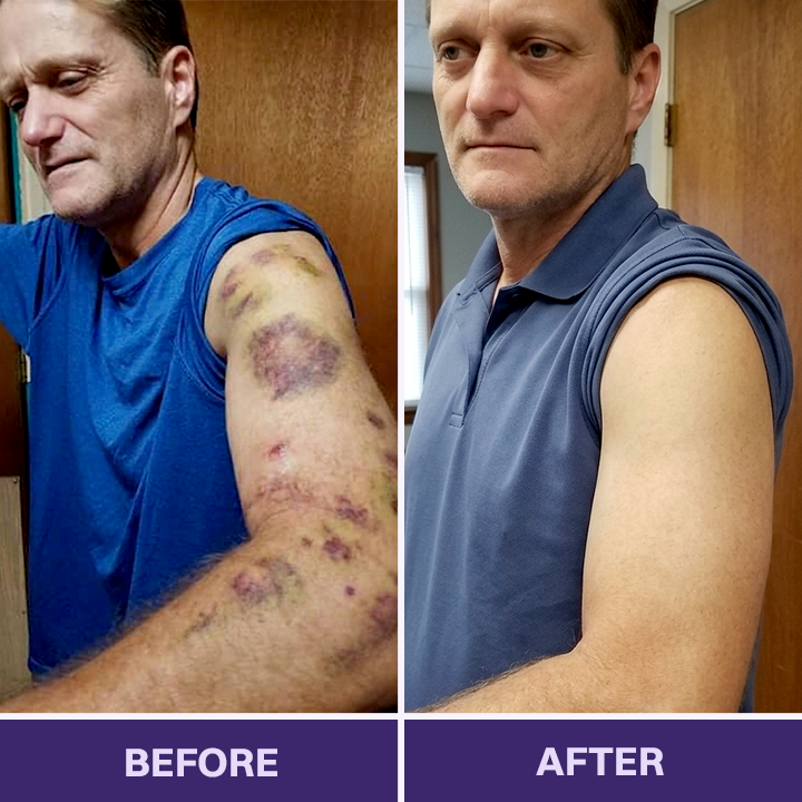 🌿✨Evolvion® Bruise Repair & Skin-Strengthening Cream-Advanced daily care for bruise-prone skin