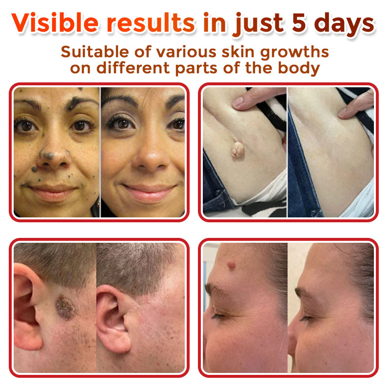 👩‍⚕️👩‍⚕️ GFOUK® MicroNeedle Botanic Skin Tag Removal Patch 🇬🇧 Made in the UK(For the removal of soft fibromas/skin tags, warts, and acne pimples)