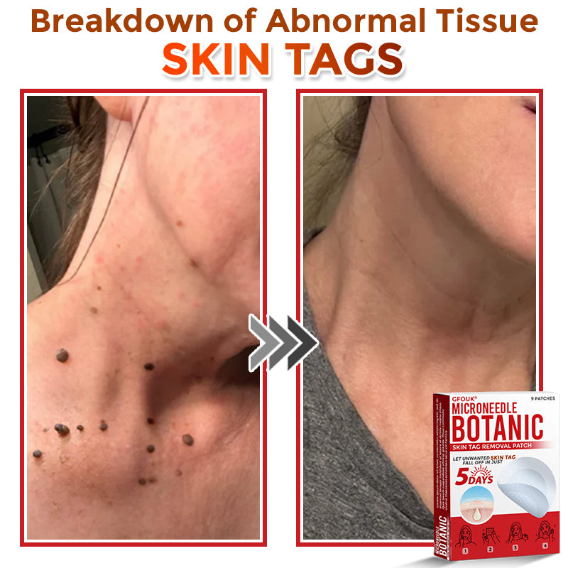 👩‍⚕️👩‍⚕️ GFOUK® MicroNeedle Botanic Skin Tag Removal Patch 🇬🇧 Made in the UK(For the removal of soft fibromas/skin tags, warts, and acne pimples)
