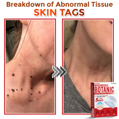 👩‍⚕️👩‍⚕️ GFOUK® MicroNeedle Botanic Skin Tag Removal Patch 🇬🇧 Made in the UK(For the removal of soft fibromas/skin tags, warts, and acne pimples)