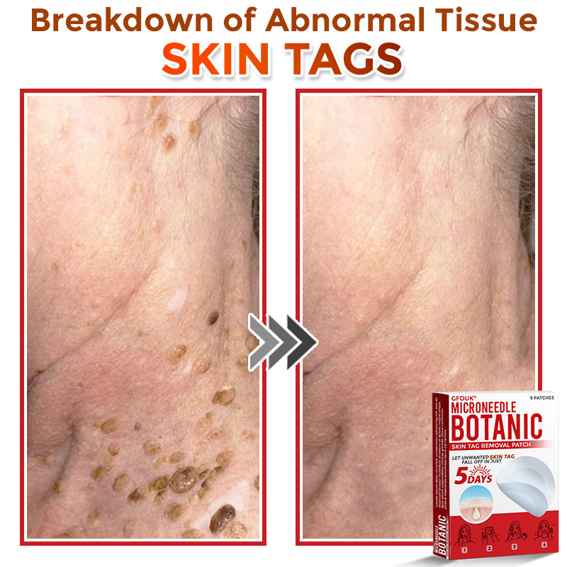 👩‍⚕️👩‍⚕️ GFOUK® MicroNeedle Botanic Skin Tag Removal Patch 🇬🇧 Made in the UK(For the removal of soft fibromas/skin tags, warts, and acne pimples)
