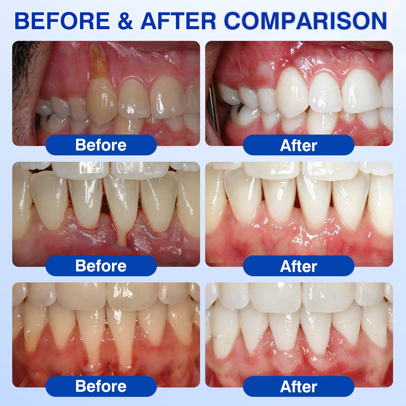 🇬🇧👨‍⚕️🦷🛡️Evolvion® GumRevive Periodontal Repair Gel