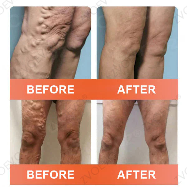 😍🎁Zvoevo® Vein Ease Microneedle Care Patch(For Spider Veins, Varicose Veins, Swelling & Leg Fatigue)